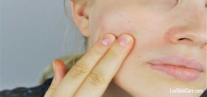 Acne Dark Spots Removal Home Remedies