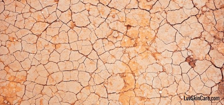 Can Acne Be Caused by Dry Skin?
