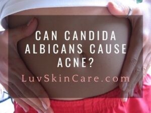 Can Candida Albicans Cause Acne?