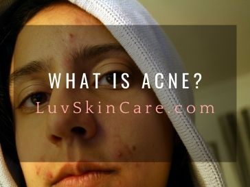 What Is Acne?